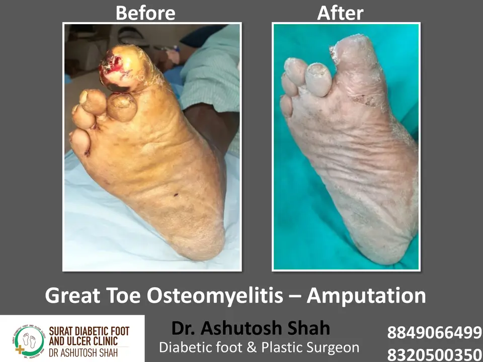 Diabetic Foot  PPT sunita.pptx-40.webp